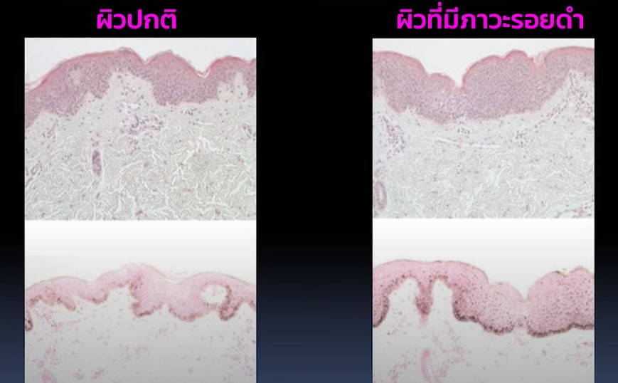 ผิวที่มีรอยดำ