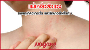 แพ้เหงื่อตัวเอง