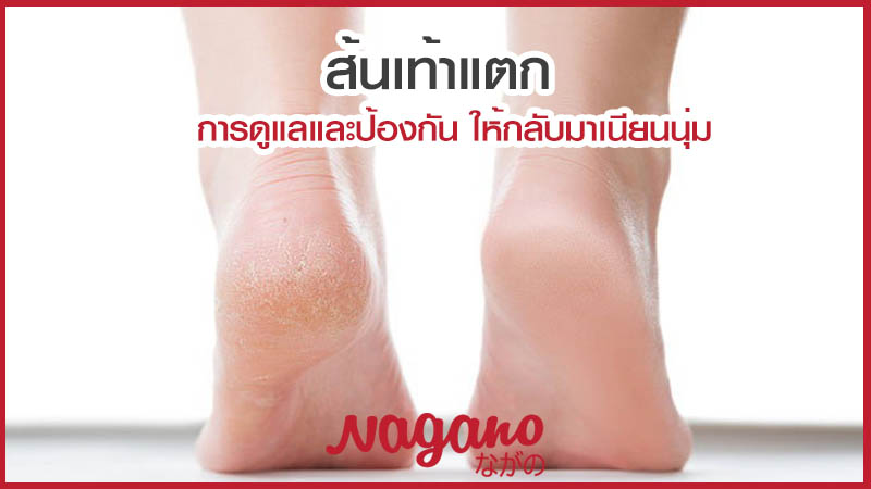 ส้นเท้าแตก